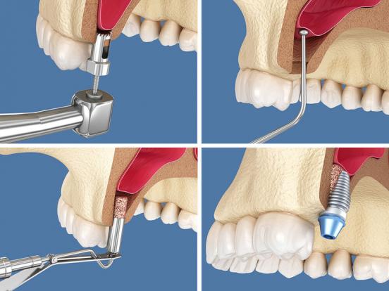 اگر برای ایمپلنت دندان در فک بالا به شما گفته‌اند «استخوان کافی ندارید»، لیفت سینوس (Sinus Lift) یک راه‌حل علمی، ایمن و قابل پیش‌بینی است.